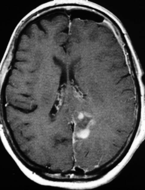 2: Gross Total resection of Glioblastoma A: SE T1 weighted sequence after
