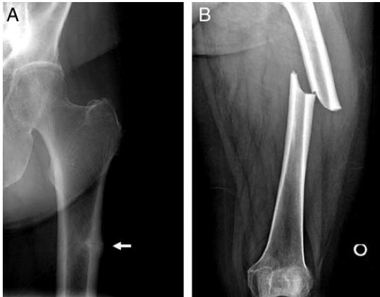 ATYPICAL FRACTURES OF THE FEMUR Watts NB and