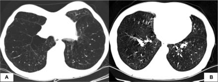 Asthma and COPD are easily confused: CT scans of two subjects with clinical histories that are consistent with COPD Both patients had similar history of tobacco use, and neither had symptomatic