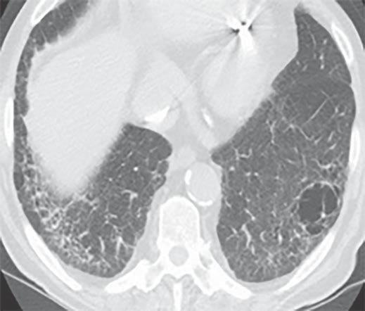 analyze in a specific patient. C Fig. 10 68-year-old man., CT image through lower lungs is normal. There was paraseptal and centrilobular emphysema in upper lungs (not shown).