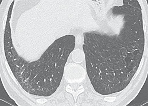 Overall CT findings are nonspecific. C, Three years later, CT image obtained through lower lungs with patient in supine position shows new peripheral reticulation in both lower lungs.