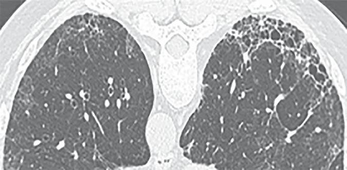 Gruden TLE 1: High-Resolution CT Criteria for Usual Interstitial Pneumonitis (UIP) Pattern. UIP (all four features) 1. Subpleural, basal predominant 2. Reticular abnormality 3.