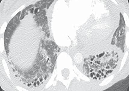 CT of Idiopathic Pulmonary Fibrosis C D Fig. 1 (continued) Four patients with honeycomb cysts in lungs. C, 47-year-old woman with scleroderma and fibrotic nonspecific interstitial pneumonitis.