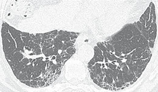 Whether this is honeycombing or severe traction bronchiectasis is not clinically relevant (see text). Note right heart dilatation related to her known pulmonary hypertension.