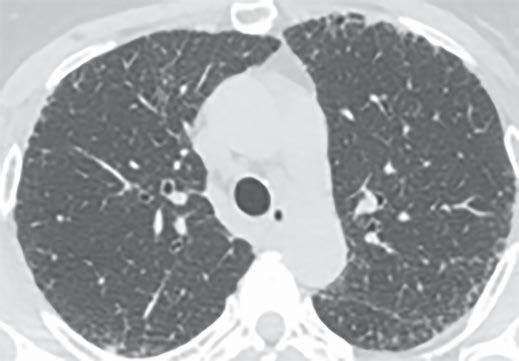 Gruden Fig. 3 72-year-old man with usual interstitial pneumonitis (UIP) and idiopathic pulmonary fibrosis (IPF).