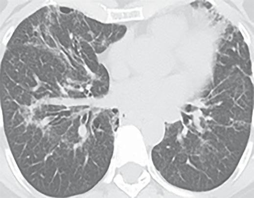ppearance is heterogeneous with normal peripheral lung alternating with zones of minimal reticulation and other areas of more extensive fibrosis and bronchiolectasis.