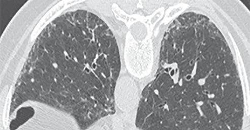 CT of Idiopathic Pulmonary Fibrosis TLE 2: Proposed Guideline Revisions for Usual Interstitial Pneumonitis (UIP) Pattern. UIP (all four features) a 1.