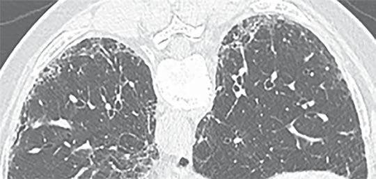 Heterogeneous appearance in the subpleural lung both on single images and on the examination as a whole. Probable UIP 1. The findings in () with the exception of (3) C.
