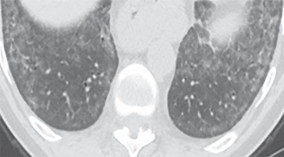 Outer right lower lung is spared, and process is fairly homogeneous in appearance. CT findings are consistent with NSIP and not consistent with usual interstitial pneumonitis (UIP) pattern.