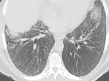 CT of Idiopathic Pulmonary Fibrosis Usual Interstitial Pneumonitis and Nonspecific Interstitial Pneumonitis Katzenstein and colleagues [33] described NSIP in 1994 as a distinct form of interstitial