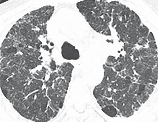 Gruden Fig. 8 57-year-old woman with chronic progressive dyspnea and cough., CT image through upper lungs shows heterogeneous lung attenuation with peripheral reticulation.
