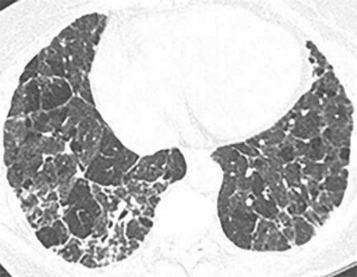 lthough clinical presentation suggested idiopathic pulmonary fibrosis, CT findings are more suggestive of chronic hypersensitivity pneumonitis (HP) (see text).