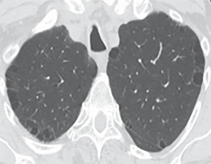 CT of Idiopathic Pulmonary Fibrosis lung volume affected) in patients with IPF and found this to distinguish patients with physiologically significant emphysema.