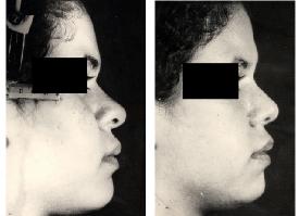 Pousti et al. nasion have also some effects on the illusion of the nasal length and projection (Figure 3). Fig.