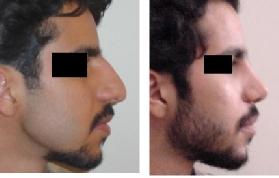 Management of radix in rhinoplasty high radix is encountered (Figure 5). Occasionally, both the bone and soft tissue should be addressed.