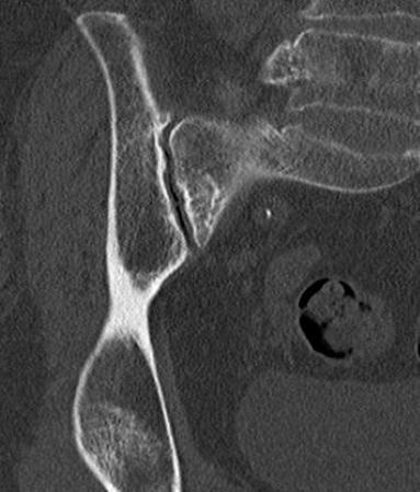 acute abnormality CT showed healed right sacral