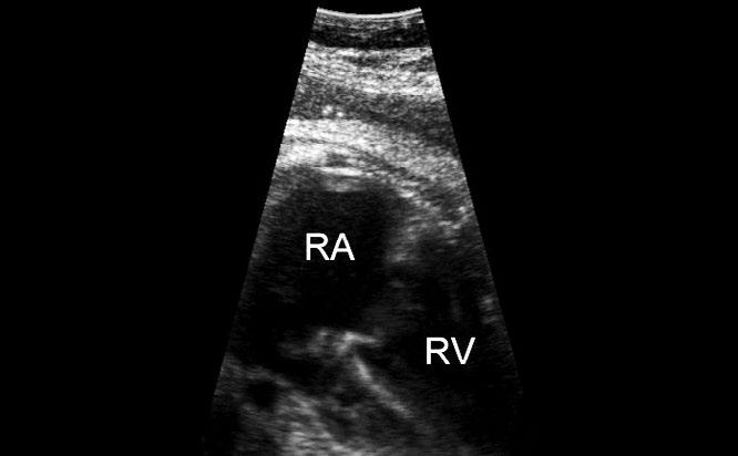30 Fig. 1 Fetal ultrasound at 38 weeks gestation: enlarged right atrium (RA) and right ventricle (RV).