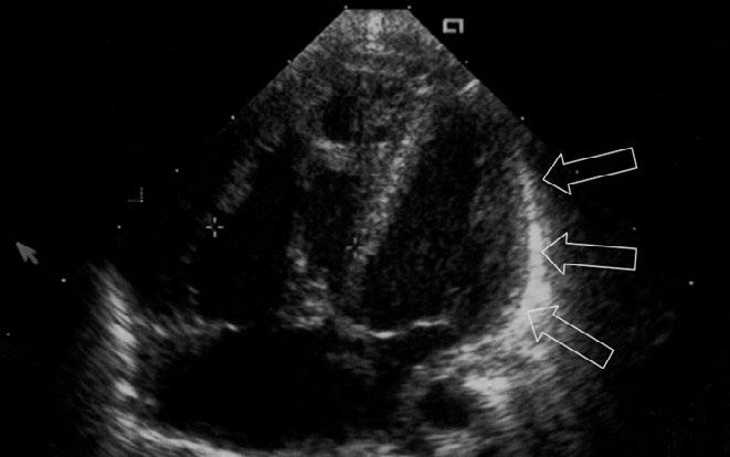 31 EM aorta heart Fig. 2 Postnatal echocardiography (day 1): right ventricular hypertrophy (arrows).