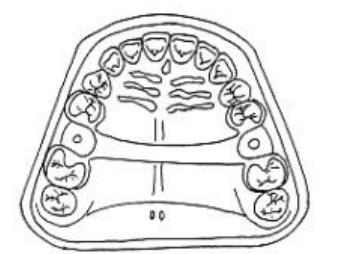 6- Combination anterior and posterior palatal bar-type connector (Ring design): Structurally, this combination of major connectors exhibits many of the same disadvantages as the single palatal bar.