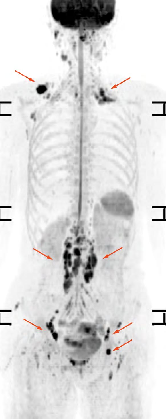 Whole body diffusion A 61-year-old female with a malignant