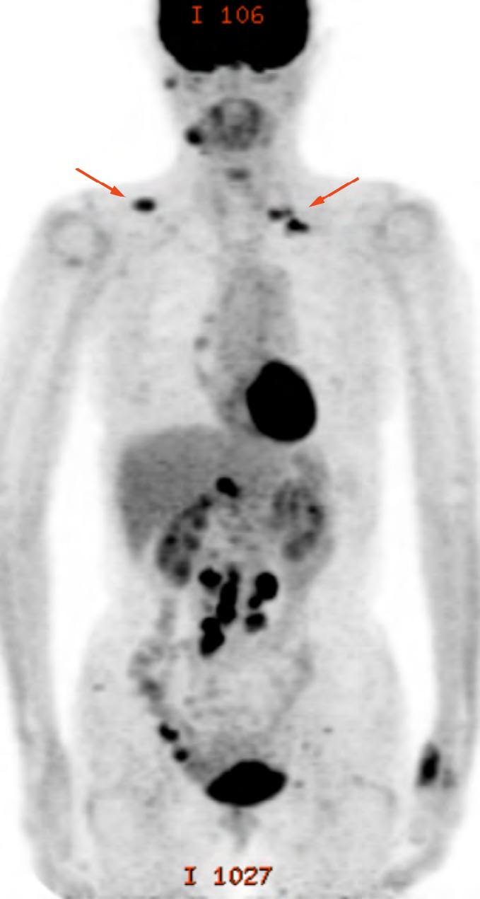 PET, which allows visualization of the small pelvic lesions