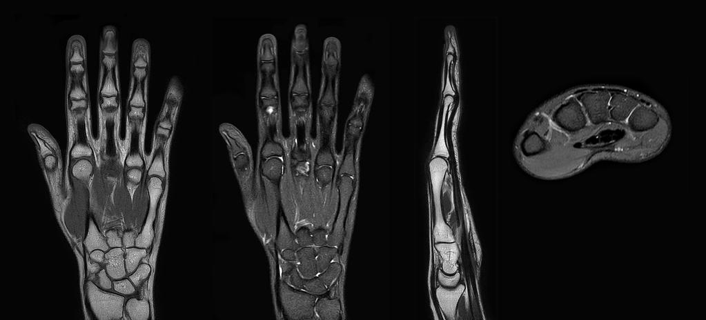 Clinical cases from Radiology Schiffer MRI of hand and wrist with large FOV Prodiva imaging of the hand