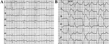 Chinese Medical Journal 2009;122(10):1133-1138 1135 Ventricular tachycardia with left bundle-branch block (LBBB-VT) was the most frequent arrhythmic event.