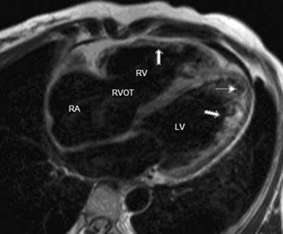 Typical morphologic changes were seen in the RV of the patient with the episode of polymorphic VT (Figures 1, 2).
