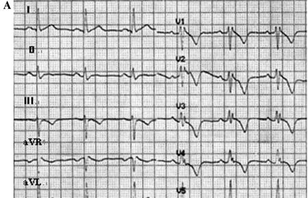 B: The epsilon wave on ECG with crbbb from another patient. Treatment and follow-up The acute success was achieved in 15 (68%) out of 22 patients who underwent RFCA for VT.