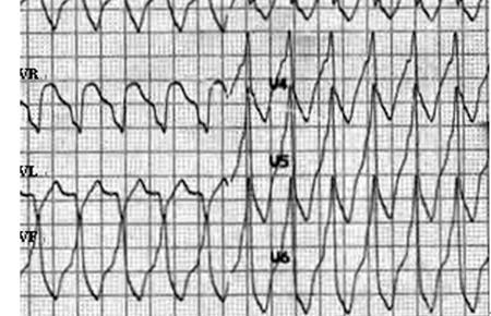 All patients taking drugs only experienced 1 or more episodes of VT and most of VTs were terminated by external cardioversion.