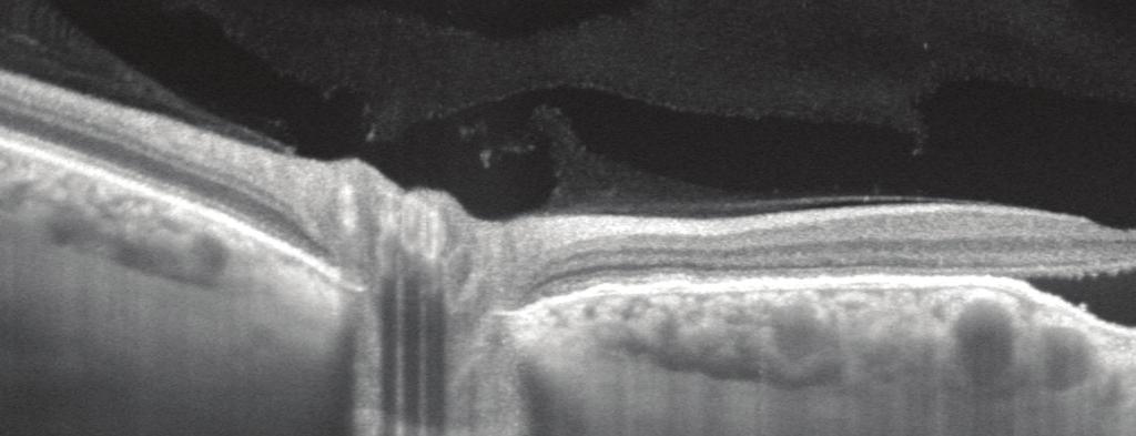 HD Spotlight 16 mm B-scan of choroidal excavation Image courtesy of Prof. F.G.