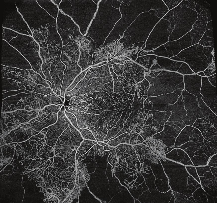 visualization of retinal vasculature with a field of view up to 70º Ultra-widefield AngioPlex montage of proliferative diabetic retinopathy, superficial layer Image