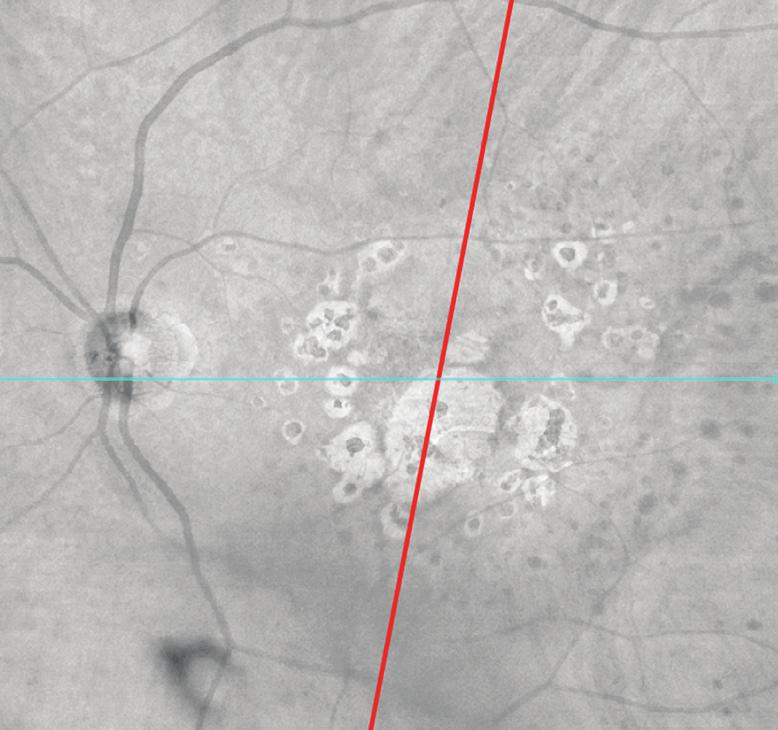 AngioPlex maps provide a full view of the retina at 3x3, 6x6, 9x9 or 12x12