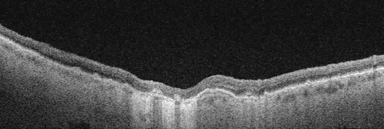 ocular structures at any depth from vitreous to sclera AngioPlex OCT
