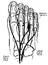 Bencardino et al. Fig. 1. Drawing shows intermetatarsal nerve. Note third intermetatarsal nerve passing underneath intermetatarsal ligament.