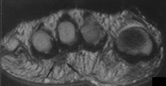 Bencardino et al. Fig. 3. 41-year-old woman without clinical symptoms of Morton s neuroma.