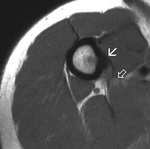 B, Oblique image from bone scan shows focal radionuclide uptake in proximal humerus (arrow).