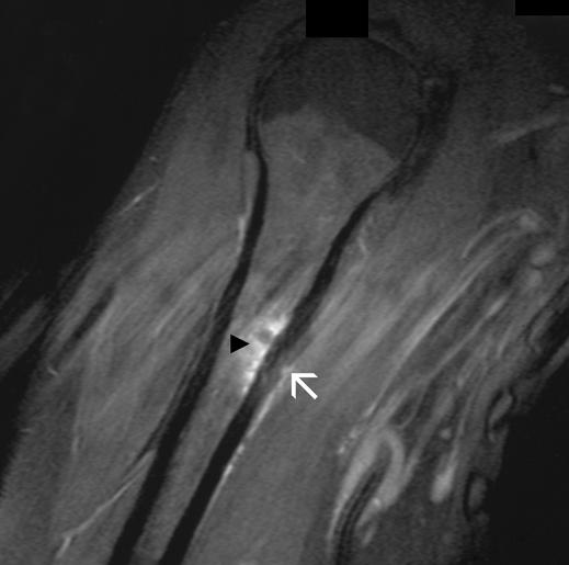 E Fig. 1 (continued) 42-year-old woman referred from orthopedic oncology with concern for sarcoma with typical imaging appearances of latissimus dorsi tendon injury pseudotumor.