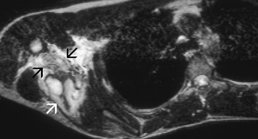 B, Corresponding axial T2-weighted MR image shows extensive partial tear of latissimus dorsi and teres major tendons (black arrows) and muscle with hemorrhage (white arrow) more posteriorly.
