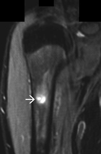 Pseudotumor of the Upper Limb The altered bone marrow findings may dominate the picture with the more subtle tendon findings being overlooked.