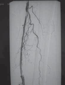 Kod jednog pacijenta postavljena su dva nitinolska samoekspandirajuća stenta dimenzija 5 x 60 i 5 x 40 mm, sa preklapanjem od cca 10 mm, jer je u toku dilatacije došlo do veće disekcije krvne žile