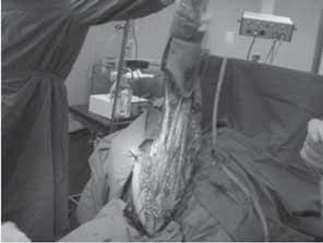 u smislu uključivanja nove terapijske sheme (Klindamicin + PenicilinG), insistira na hirurškoj eksploraciji gdje se izravno makroskopski dijagnosticira nekrotizirajući fascitis (Slika 3 i 4). Slika 6.