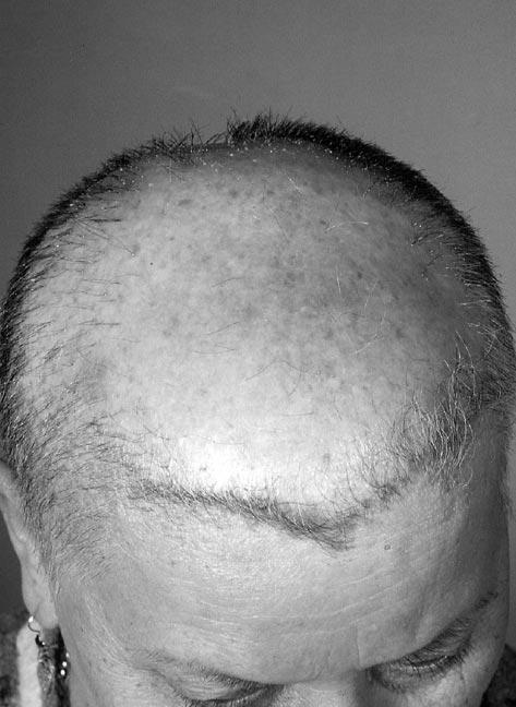Figure 3. Patient 14. Advanced scarring alopecia of the centroparietal scalp associated with loss of follicular orifices and a remaining frontal hairline. Figure 4. Patient 13.