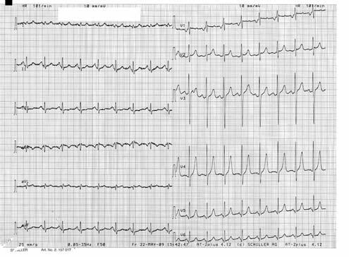 620 Interatrial block and P-terminal force in MS subjects (mean age 37 ± 11 years), without echocardiographic signs of rheumatic valve involvement, served as controls.