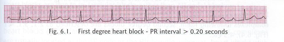 Characterized by PR Interval > 0.