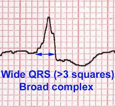 narrow QRS complexes