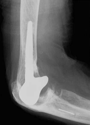 A 59-year-old woman with rheumatoid arthritis had undergone left total elbow arthroplasty with a strut bone graft on the medial side of the humerus.