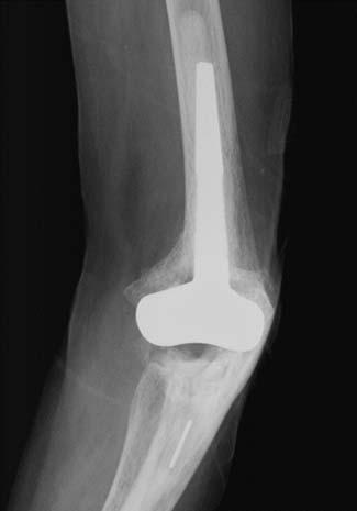 c) Radiograph seven years after operation shows no loosening of components and union of the fracture. Radiological assessment.