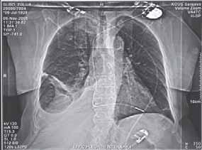 Pri prijemu jasni znaci srčane dekompenzacije uz nečujno disanje desno do 2/3 pluća te edemi na potkoljenicama.