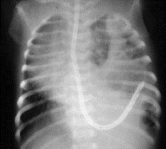 Diaphragmatic Hernia 40 Stomach & intestines enter thorax compressing lung & pushing mediastinum to the right